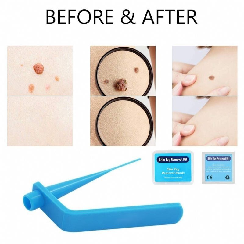 Home Micro Skin Tag Remover Set Stredný Body Mole Odstraňovač Bradavíc Pásik Na Odstránenie Tag Removal Band